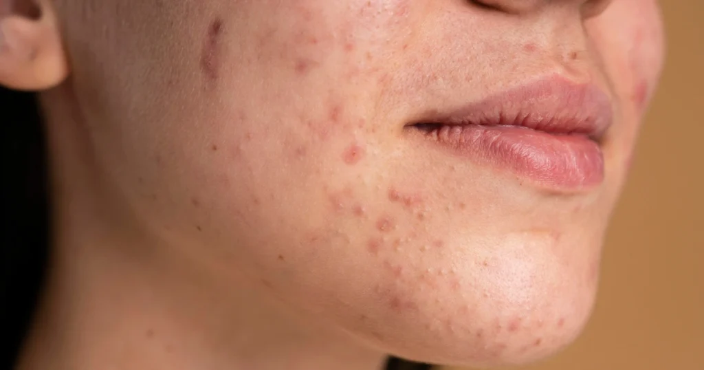 Acne fúngica ou acne comum? Saiba como diferenciar os sinais