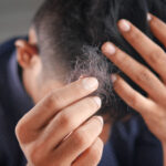 Sabonete de cetoconazol para caspa: a solução para a descamação