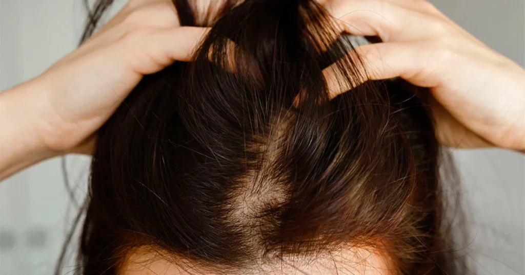 Alternativa ao shampoo de cetoconazol: evite ardor e alergia